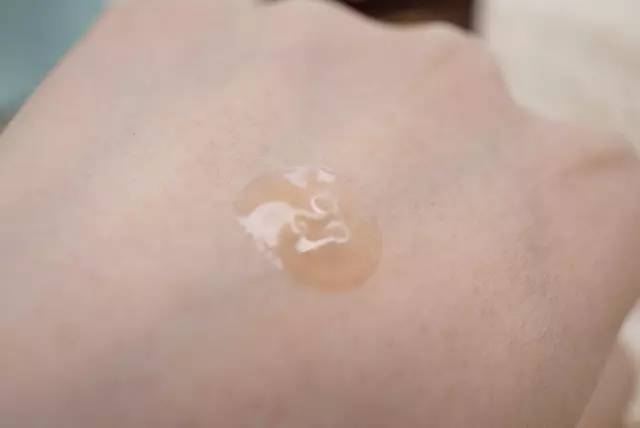 挤痘痘 冻膜