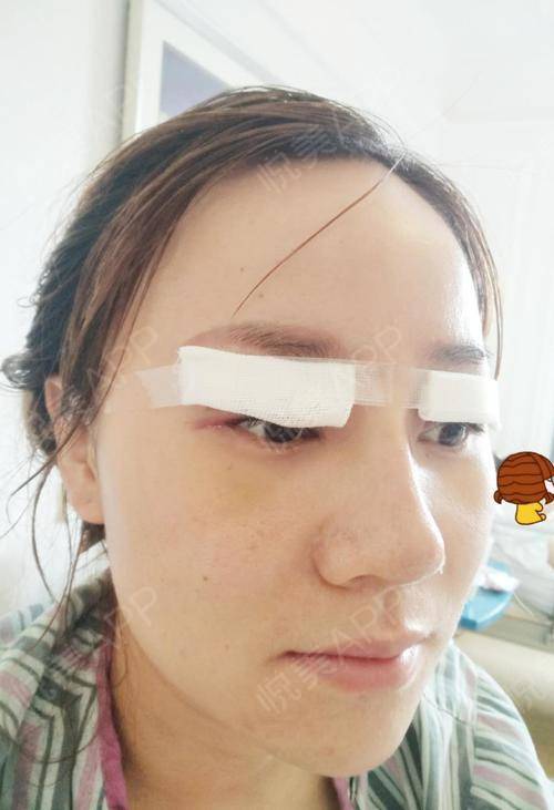 单眼皮埋线疼吗