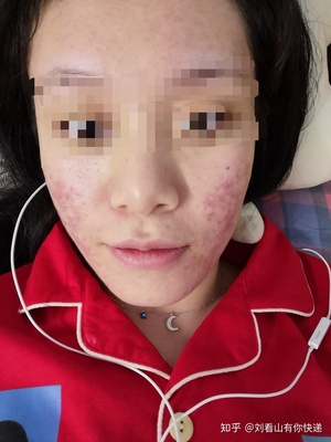 吃了两个月中药痘痘怎么还不见好