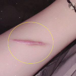 烫烧膏擦痘痘管用吗