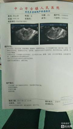 排卵期囊肿