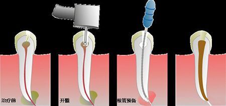 一颗牙根管要多少钱