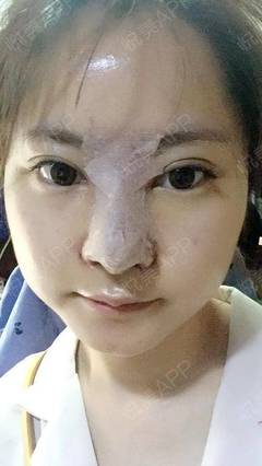 隆鼻打几天消炎针