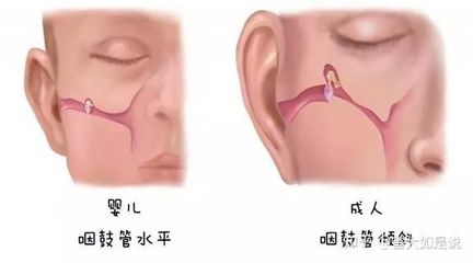 三岁宝宝中耳炎