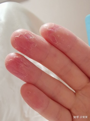 手指头褪皮是怎么回事