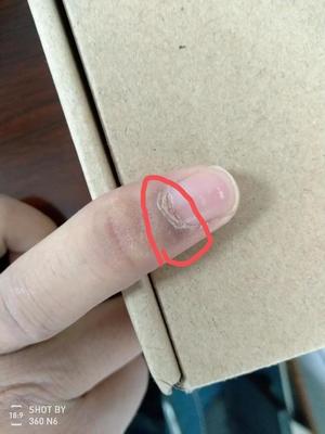宝宝指甲根部皮肤发黑