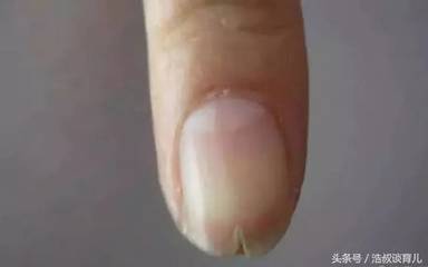 指甲破裂是怎么回事