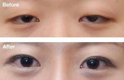 做双眼皮的形状