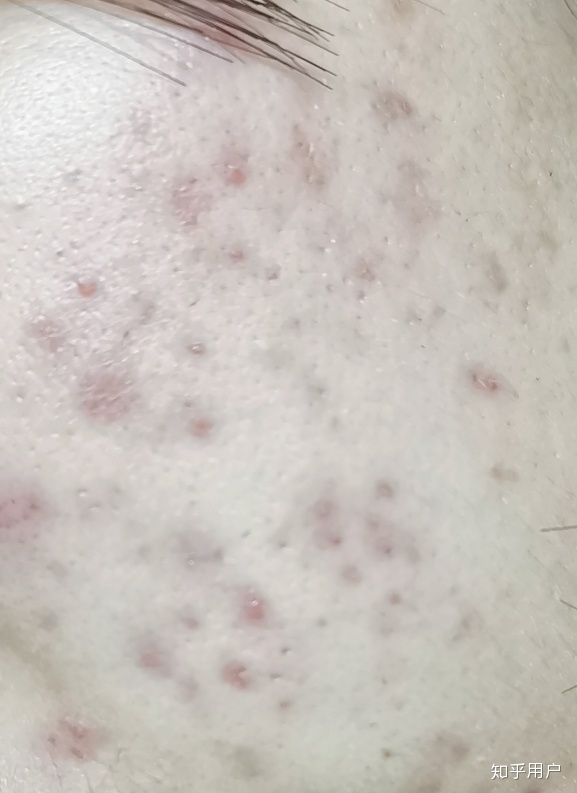 脸上的痘痘忌口鸡么