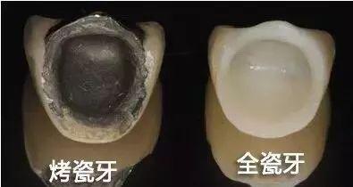 钴铬合金烤瓷牙做核磁共振可以吗