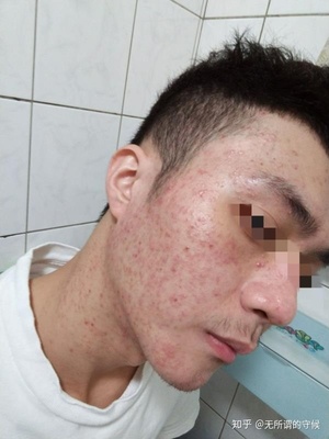 丘疹型痘痘严重么