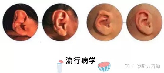 新生儿外耳畸形