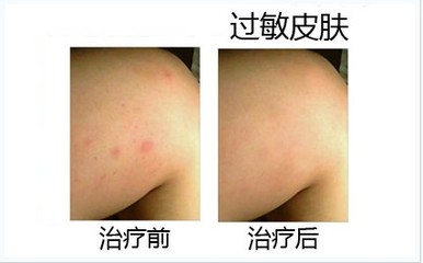 成都皮炎所治痘痘