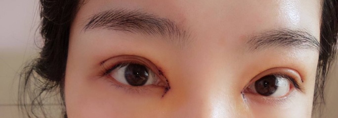 割双眼皮需要多久恢复