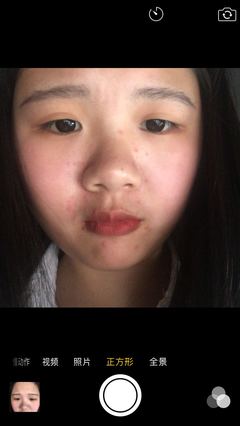痘痘长在鼻子两侧