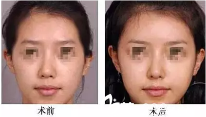 玻尿酸好吗