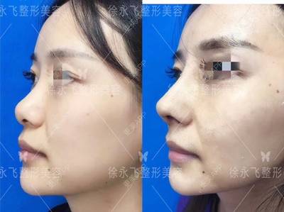 自体软骨隆鼻的缺点
