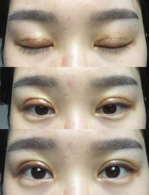 割完双眼皮忌口多久