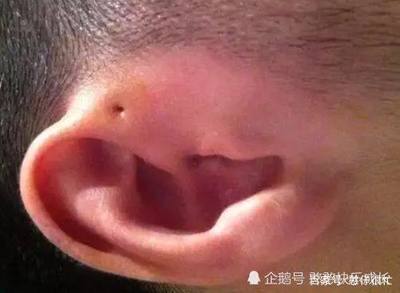 耳朵有个小孔是怎么回事