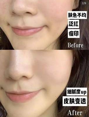 痘印变黑了还能好吗