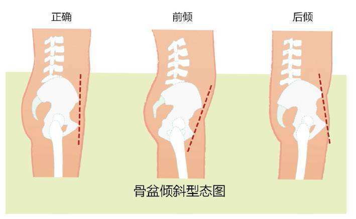 骨盆前倾肚子大