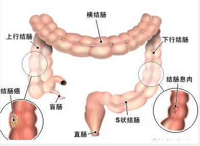结肠息肉怎么治疗