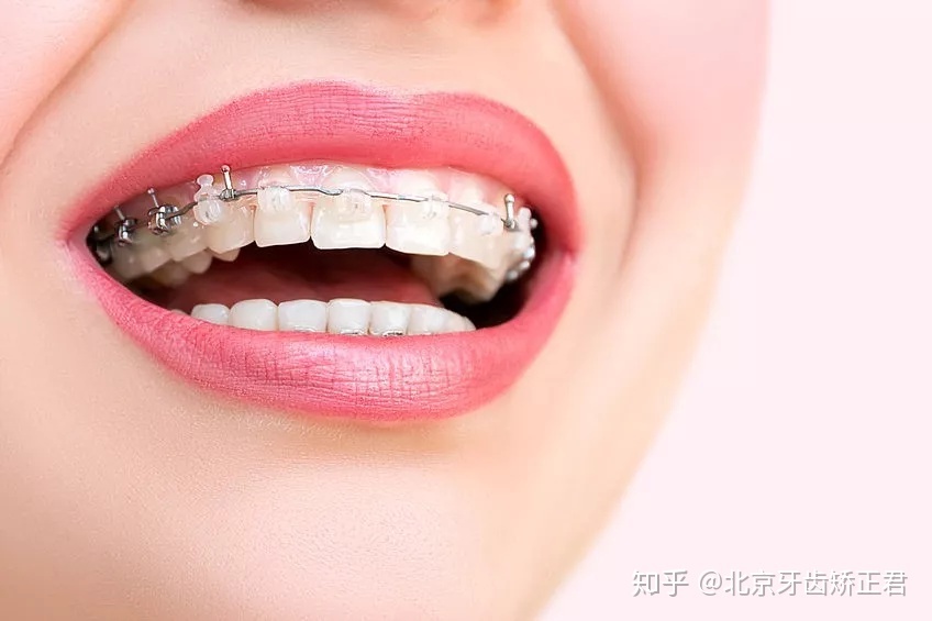 戴牙套能瘦脸吗