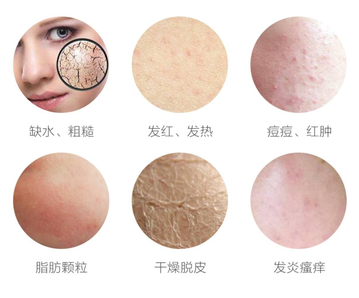 痘痘肌肤用什么牌子最好