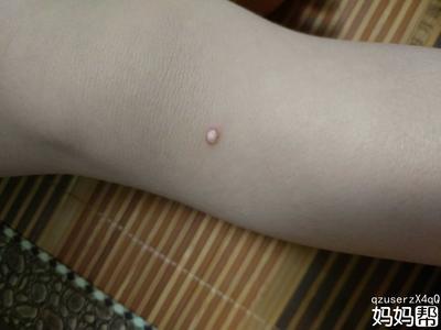 孩子背上起痘痘是怎么回事