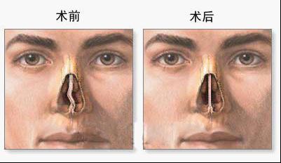 鼻中隔偏曲怎么治疗