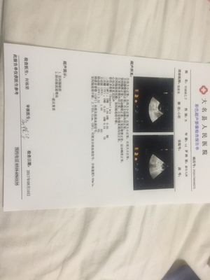 新生儿室间隔缺损