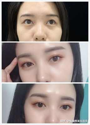 哪做双眼皮好