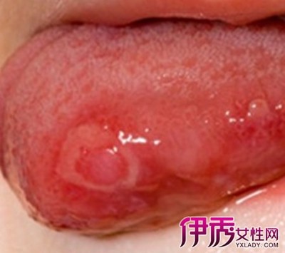 舌头长溃疡是怎么回事