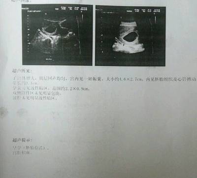 宫腔积血是怎么回事