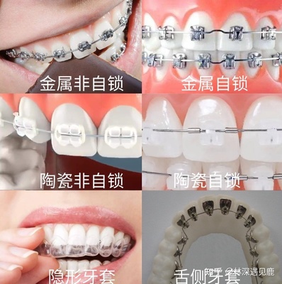 牙齿矫正的费用