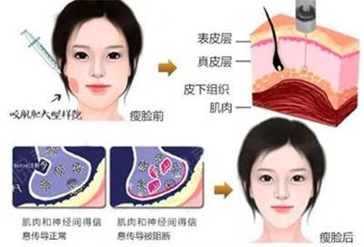 瘦脸针为什么会凹陷