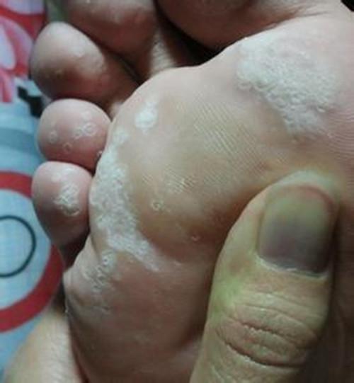 手脚潮湿是怎么回事