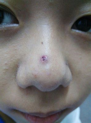 鼻子里长痘痘流血原因