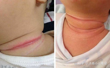 宝宝淹脖子