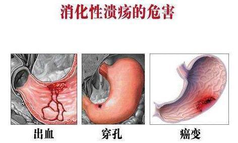 胃糜烂出血怎么治疗