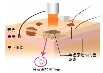 激光祛斑的过程