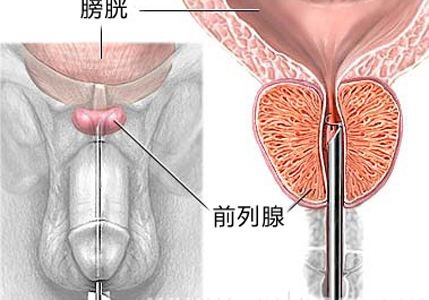 前列腺肥大是怎么回事