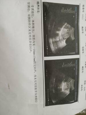 白带褐色是怀孕吗