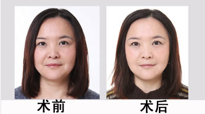 玻尿酸能打哪里