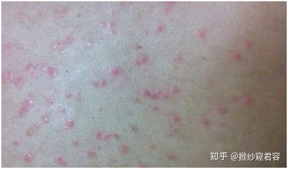 痘痘感染化脓多会消