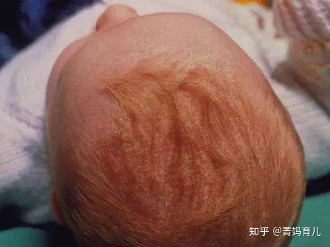 新生儿乳痂图片