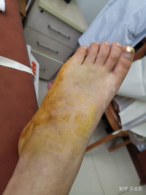 脚背疼肿是怎么回事