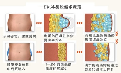 腰两侧抽脂