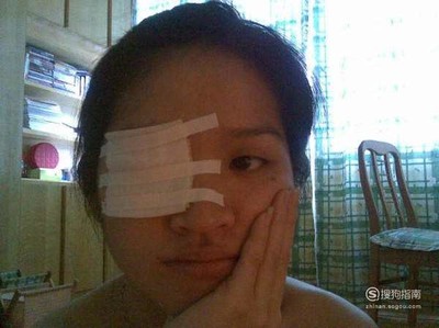 长针眼怎么治疗