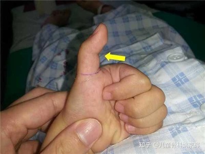 宝宝大拇指伸不直图片